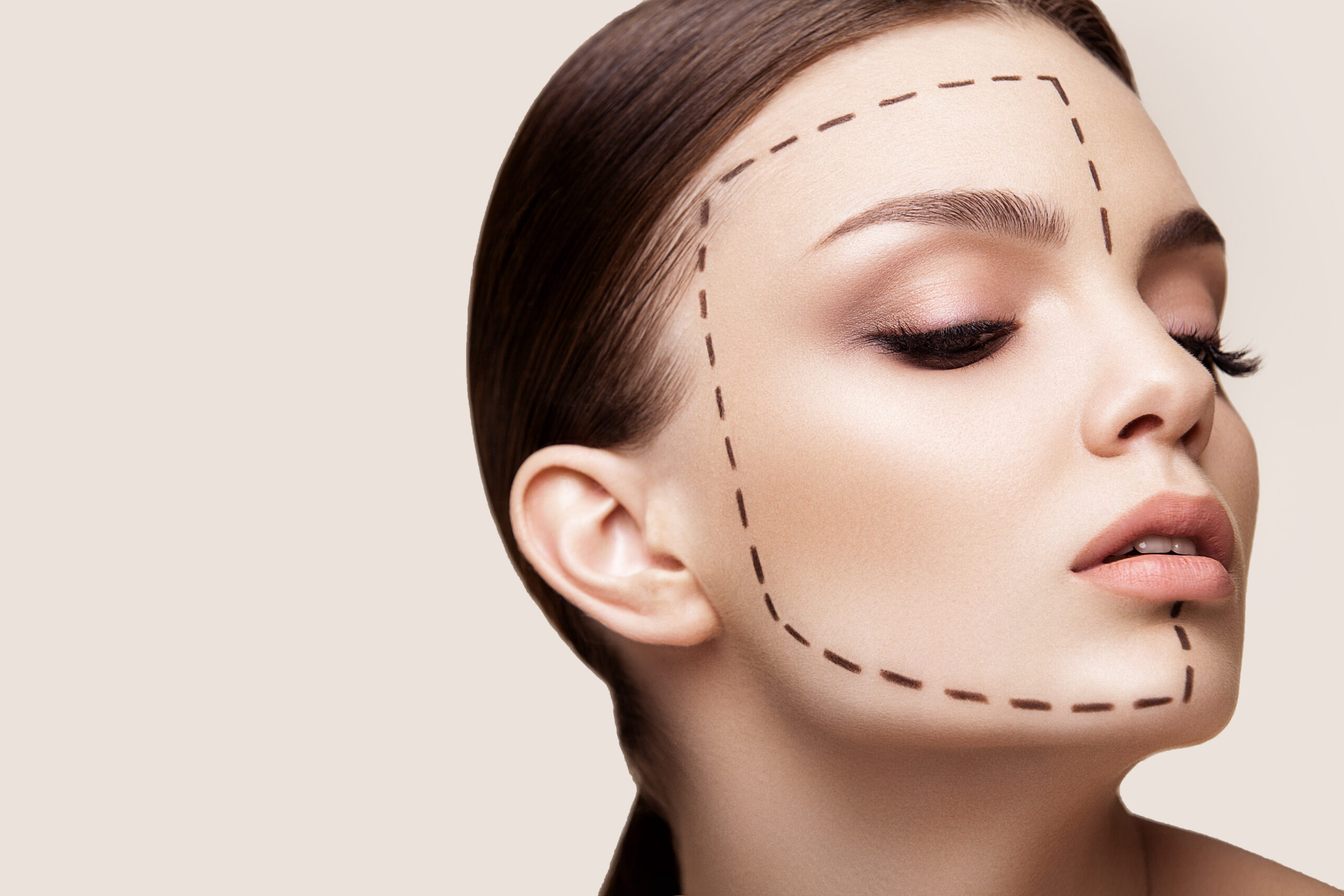 Beautiful,Woman,Before,Plastic,Surgery,Operation,Cosmetology.,Beauty,Face Image of a woman with lines drawn on her face