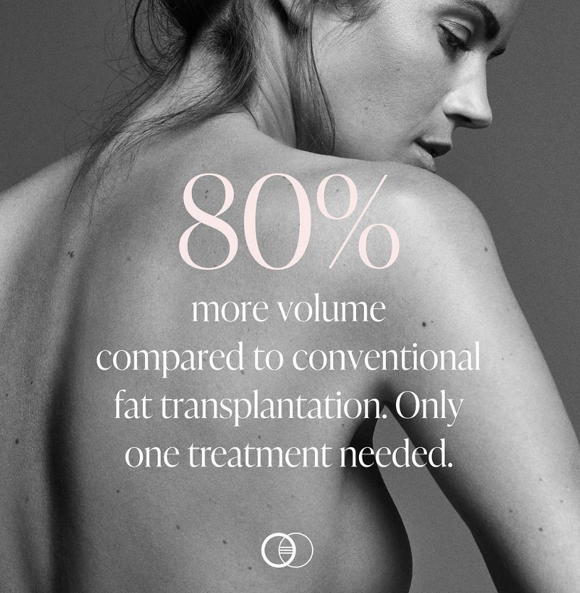 Stemform's breast technique adds 80% more volume compared to conventional fat transplantation.