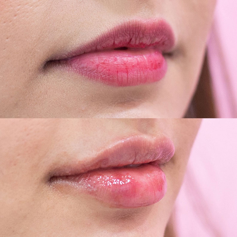 Angel Lips By Dr OBT